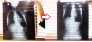 側彎症改善のレントゲン写真